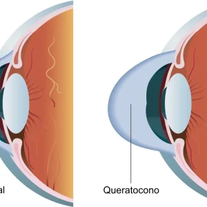 queratocono